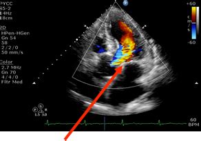 2d echo with doppler result|2D ECHO/DOPPLER STUDY .